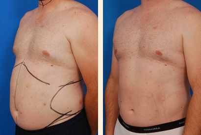 Say goodbye to stubborn belly fat Stratford upon Avon