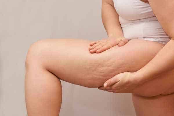 Find the best cellulite treatment Stratford upon Avon for you!