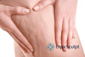 Start your journey today book your coolsculpting treatment Stratford upon Avon online today!