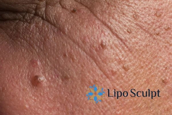 Remove skin lesions in as little as one treatment for an anti ageing Stratford upon Avon effect!