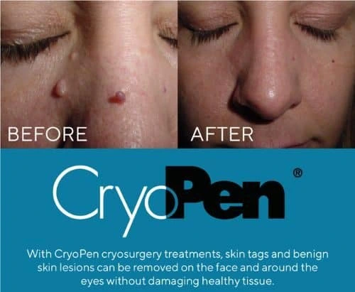 image of angiofibroma removal Stratford upon Avon using Lipo Sculpt cryopen!