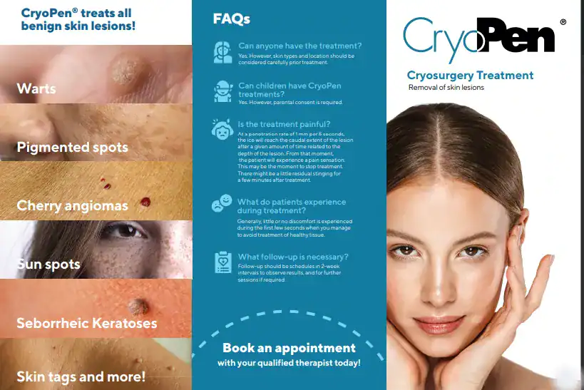 Benefits of Cryopen for seborrheic keratosis Removal Treatment Stratford upon Avon