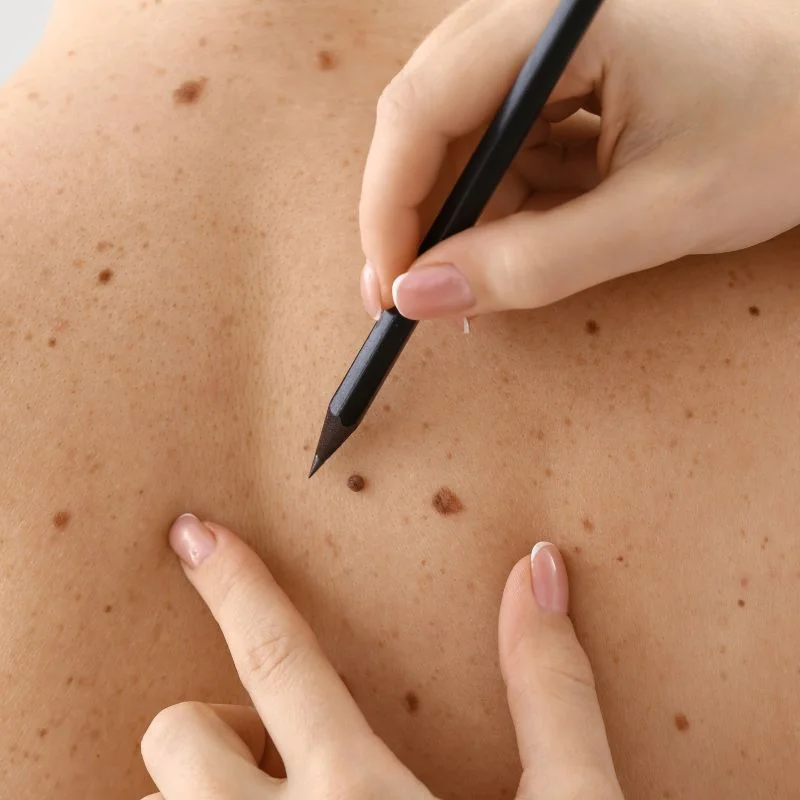 cryopen lesion removal treatment Stratford upon Avon
