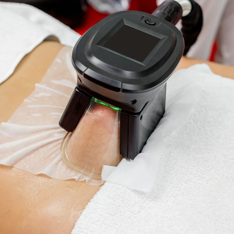Fat Freezing treatment Stratford upon Avon
